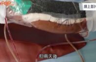 毒蚊肆虐｜叮咬一口足以致命陝西53歲男險被截肢