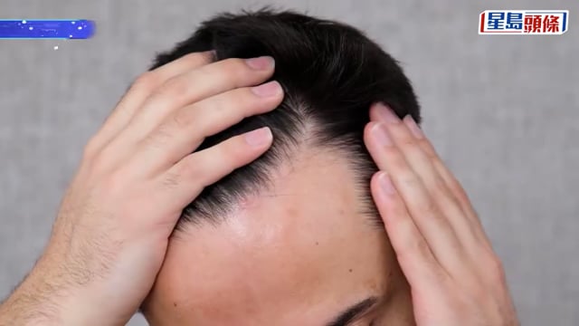 消委會植髮︱生髮療程標榜「一次見效」惟無效兼拒退款 植髮聲稱維持六年 竟一年內掉光!
