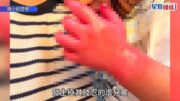 元朗虐兒案｜2歲女疑遭印傭監生撳手落滾水 皮開肉綻狂流血膿 母痛心誓言告到底