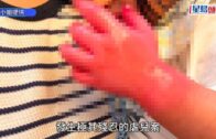 佛山網紅餐廳「拋火」追求效果狂灌96%烈酒 女博主雙手深二度燒傷｜有片